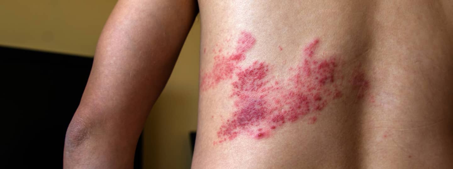 rash-shingles New test